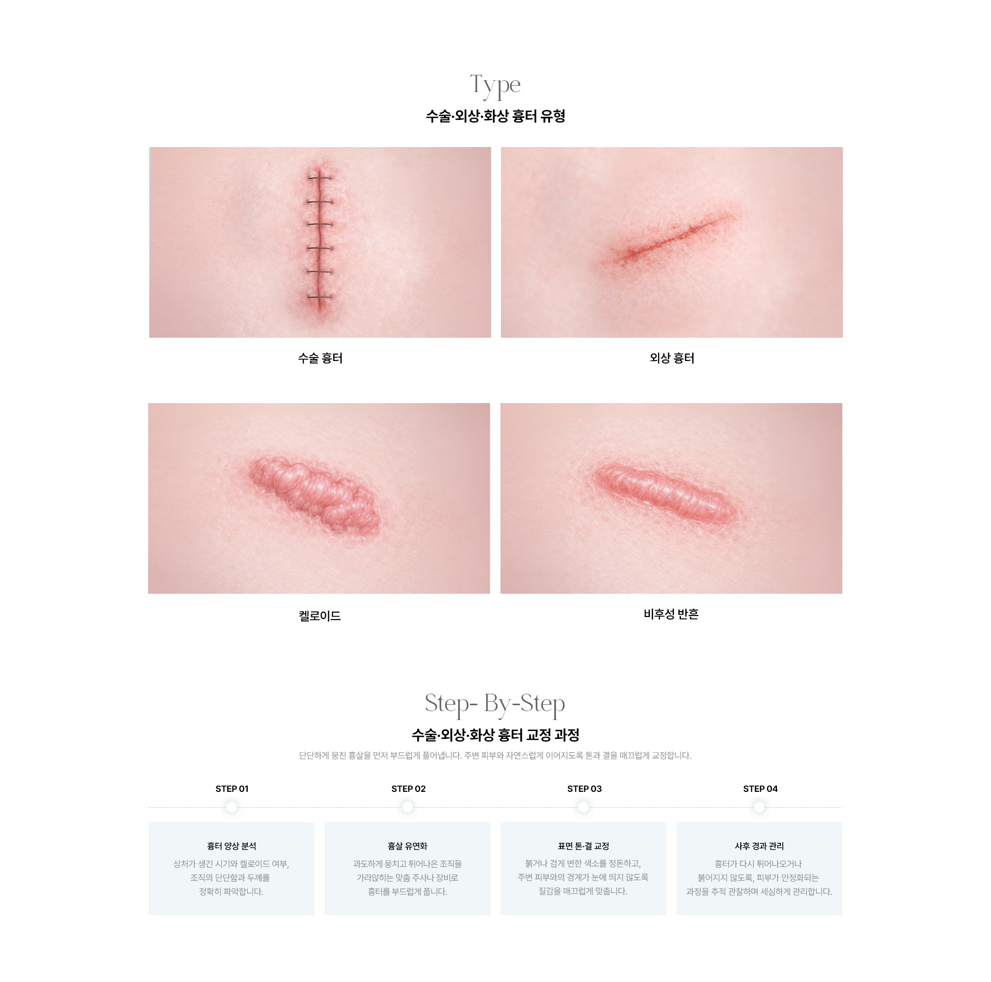 여드름 흉터 재생 과정 STEP01 정밀 진단 STEP02 유착 조직 분리 STEP03 맞춤 재생 시술 STEP04 코어 장벽 회복